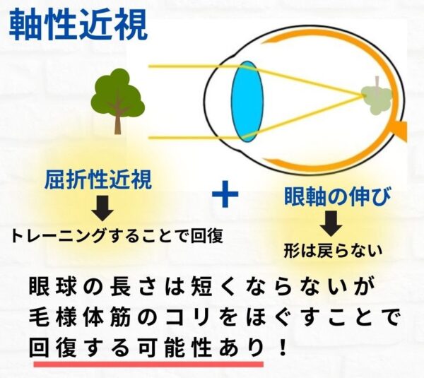 軸性近視は